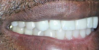 smile case transformation