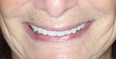 smile case transformation