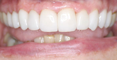 smile case transformation